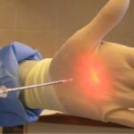 لیزر هموروئید؛ درمانی قطعی و فوری