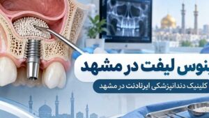 سینوس لیفت در مشهد درمان تخصصی پیش از ایمپلنت دندان در ایرانادنت