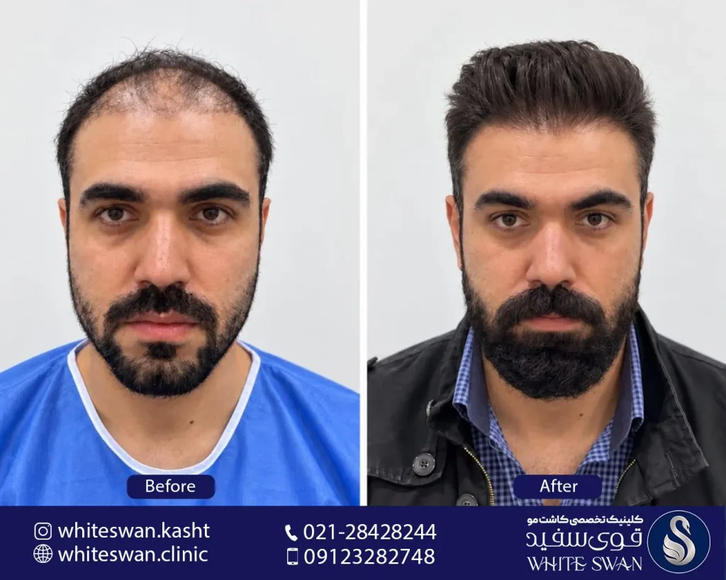 خدمات کاشت مو.